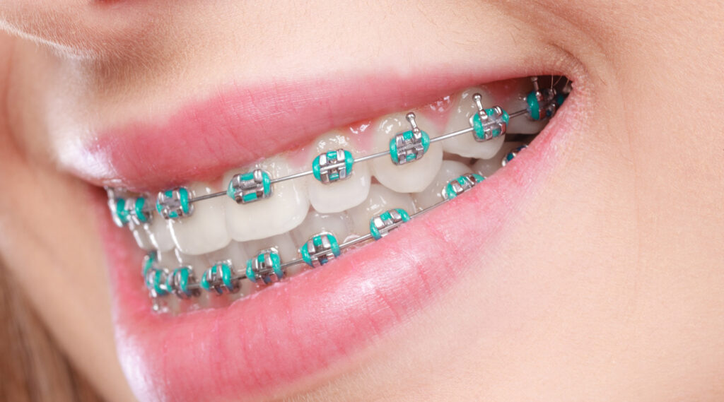 Kinrara dental in puchong - Orthodontic Treatment