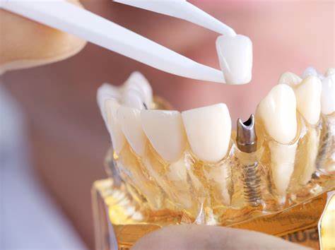 Kinrara dental in puchong - Prosthetic Dentistry